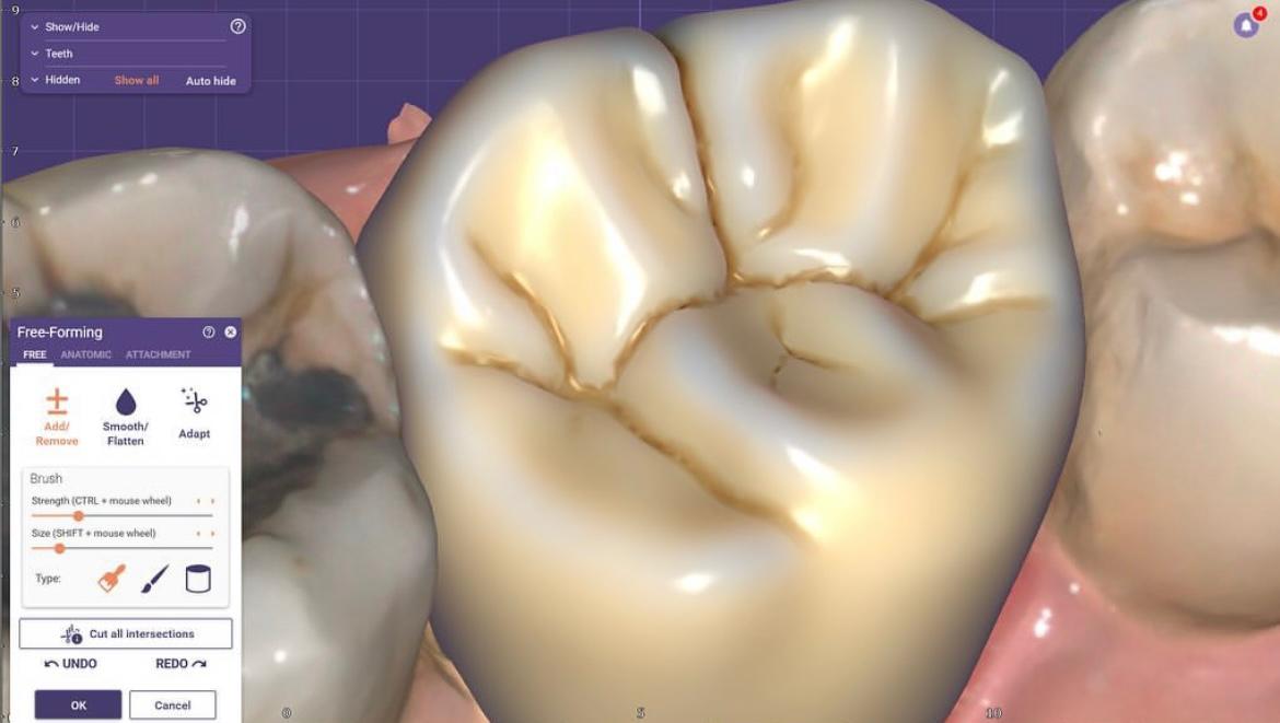 Day to day crown and bridge restorations