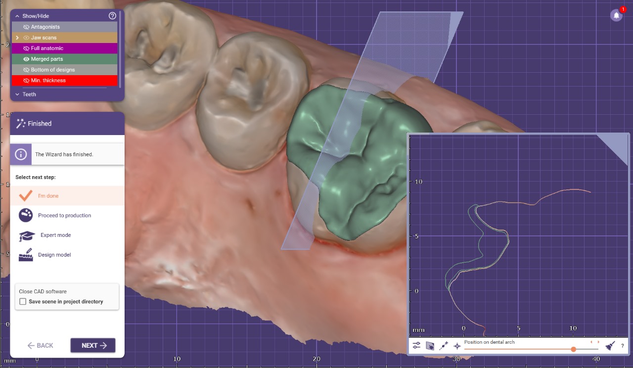 Full mouth rehabilitation