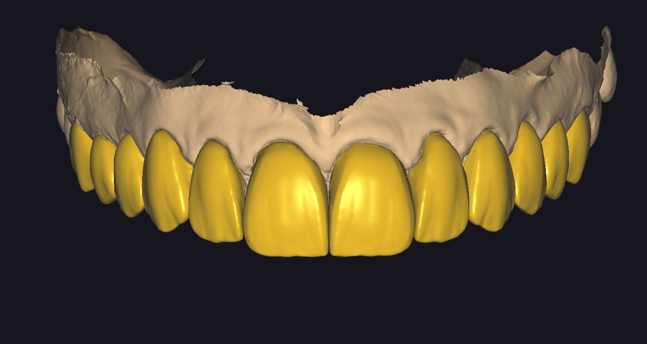 Veneers
