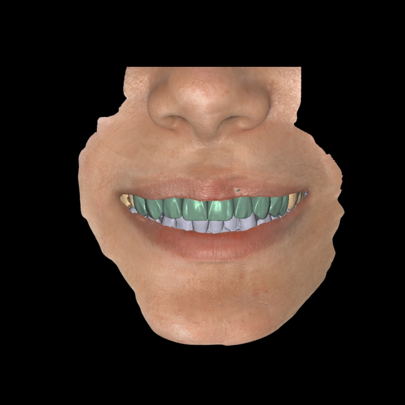 Digital Smile Design