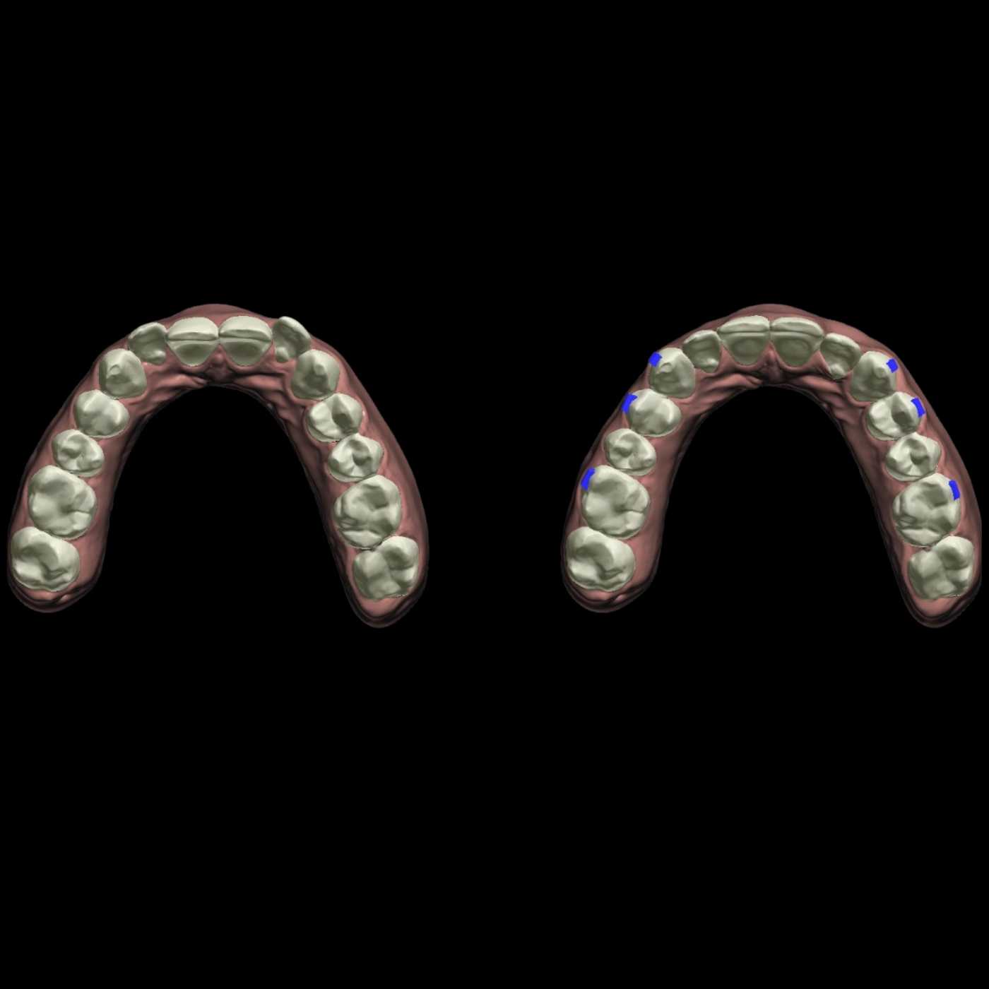 Clear Aligners